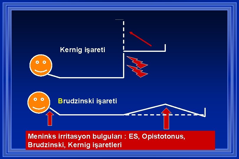 Kernig işareti Brudzinski işareti Meninks irritasyon bulguları : ES, Opistotonus, Brudzinski, Kernig işaretleri 