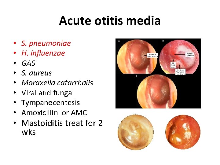 Acute otitis media • • S. pneumoniae H. influenzae GAS S. aureus Moraxella catarrhalis