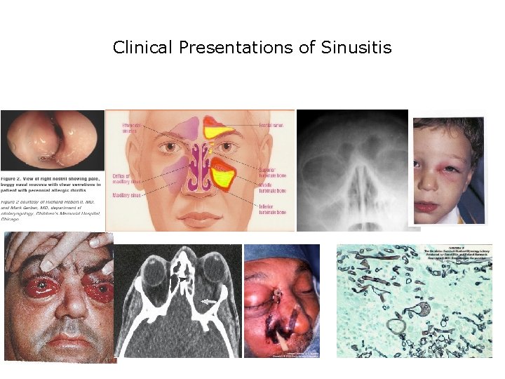 Clinical Presentations of Sinusitis 