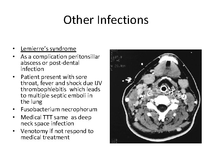 Other Infections • Lemierre’s syndrome • As a complication peritonsillar abscess or post-dental infection