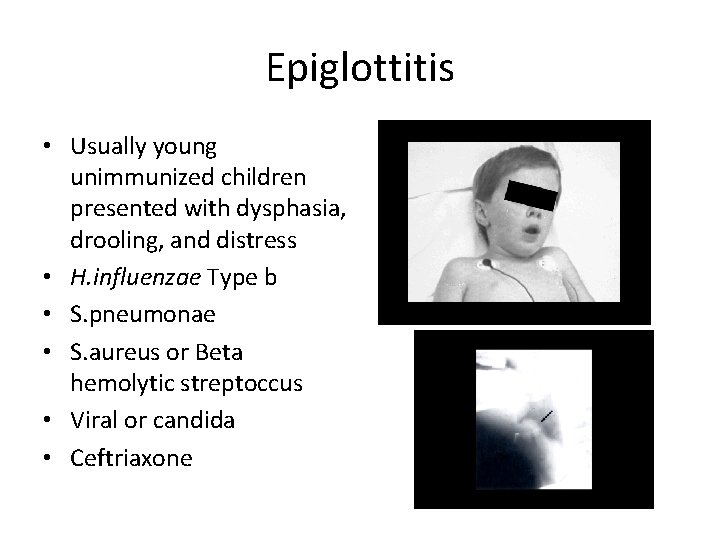 Epiglottitis • Usually young unimmunized children presented with dysphasia, drooling, and distress • H.