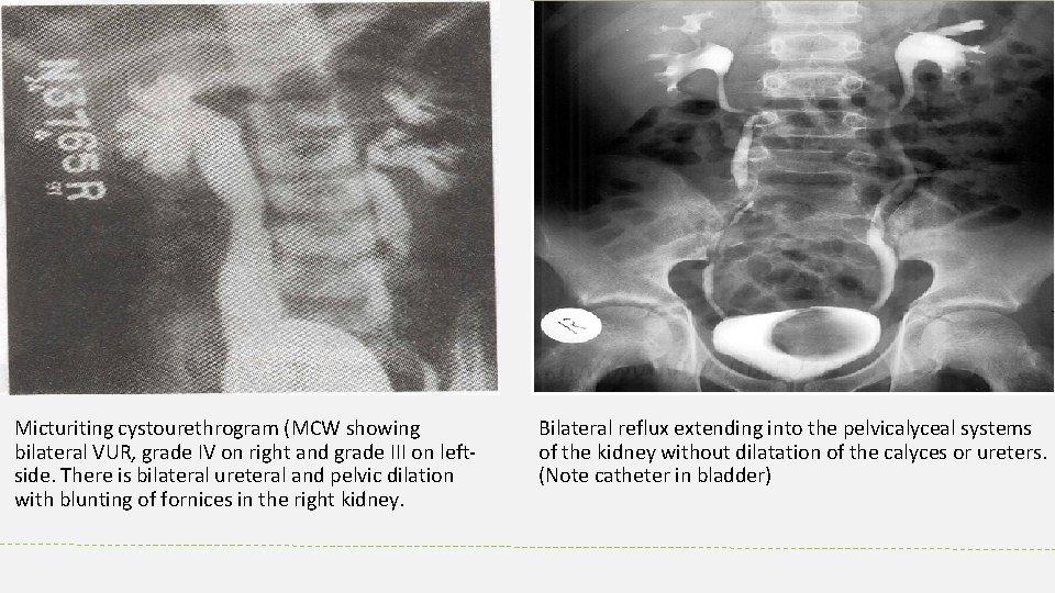 Micturiting cystourethrogram (MCW showing bilateral VUR, grade IV on right and grade III on