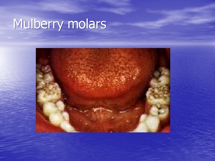 Mulberry molars 