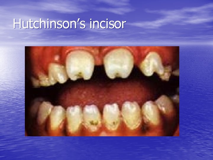 Hutchinson’s incisor 