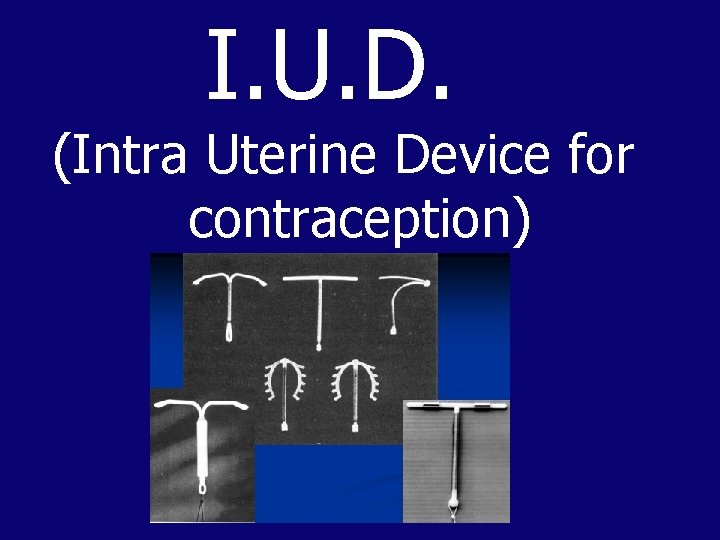 I. U. D. (Intra Uterine Device for contraception) 