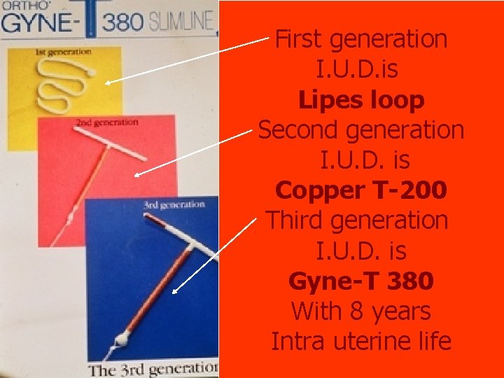 First generation I. U. D. is Lipes loop Second generation I. U. D. is