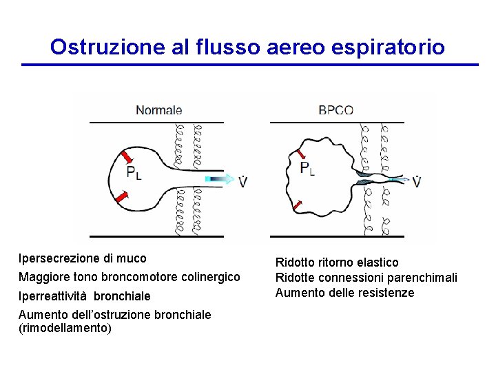 Ostruzione al flusso aereo espiratorio Ipersecrezione di muco Maggiore tono broncomotore colinergico Iperreattività bronchiale