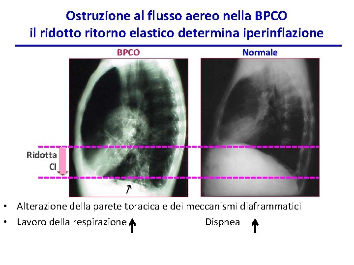 Ostruzione al flusso aereo nella BPCO il ridotto ritorno elastico determina iperinflazione BPCO Normale