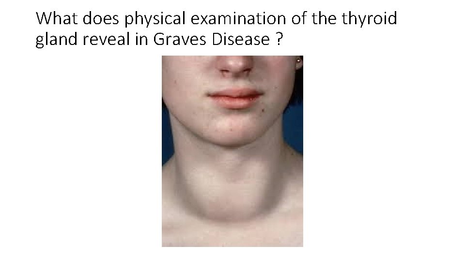 What does physical examination of the thyroid gland reveal in Graves Disease ? 
