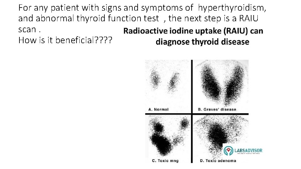 For any patient with signs and symptoms of hyperthyroidism, and abnormal thyroid function test