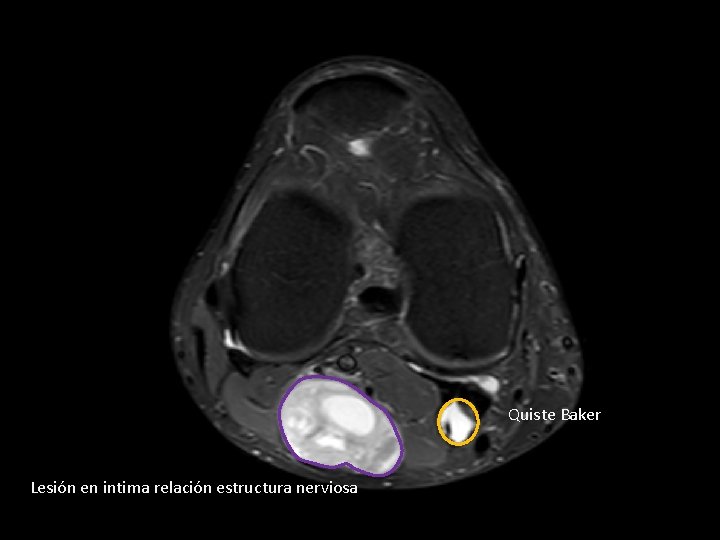 Quiste Baker Lesión en intima relación estructura nerviosa 