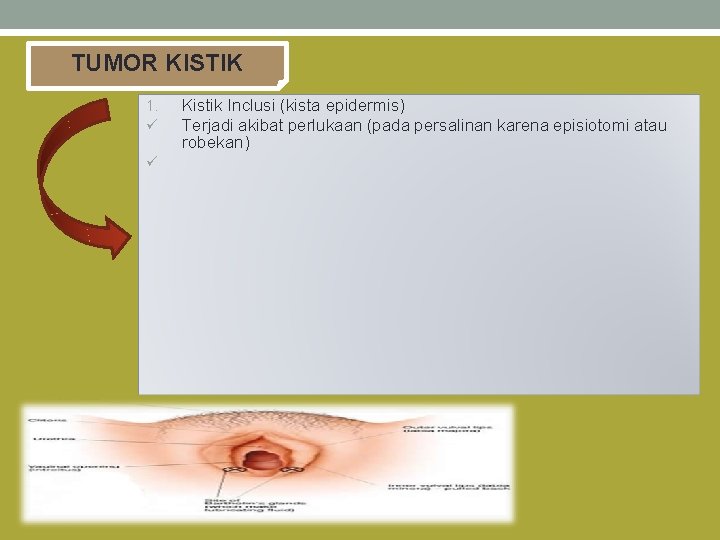 TUMOR KISTIK 1. ü ü Kistik Inclusi (kista epidermis) Terjadi akibat perlukaan (pada persalinan