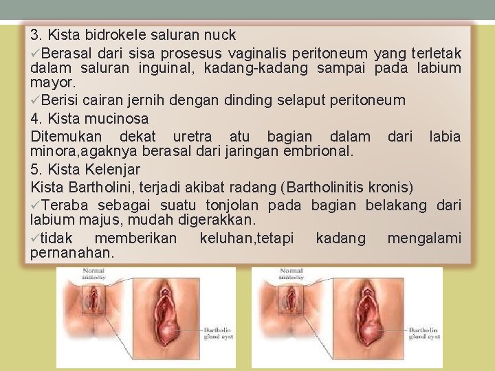 3. Kista bidrokele saluran nuck üBerasal dari sisa prosesus vaginalis peritoneum yang terletak dalam