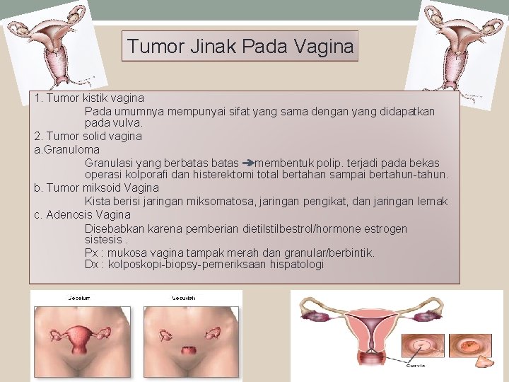 Tumor Jinak Pada Vagina 1. Tumor kistik vagina Pada umumnya mempunyai sifat yang sama