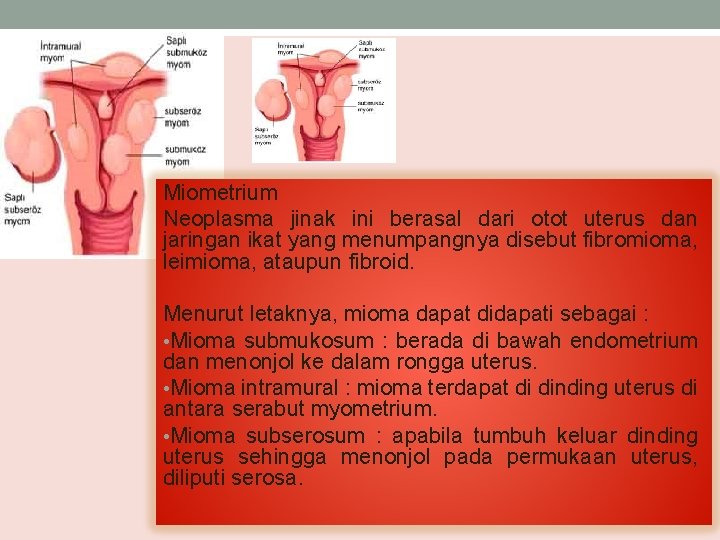 Miometrium Neoplasma jinak ini berasal dari otot uterus dan jaringan ikat yang menumpangnya disebut
