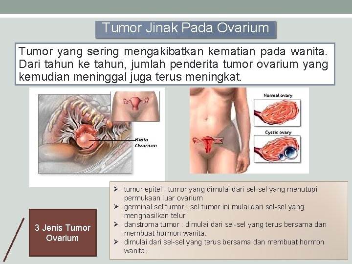 Tumor Jinak Pada Ovarium Tumor yang sering mengakibatkan kematian pada wanita. Dari tahun ke