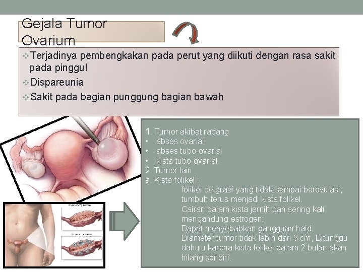 Gejala Tumor Ovarium v. Terjadinya pembengkakan pada perut yang diikuti dengan rasa sakit pada