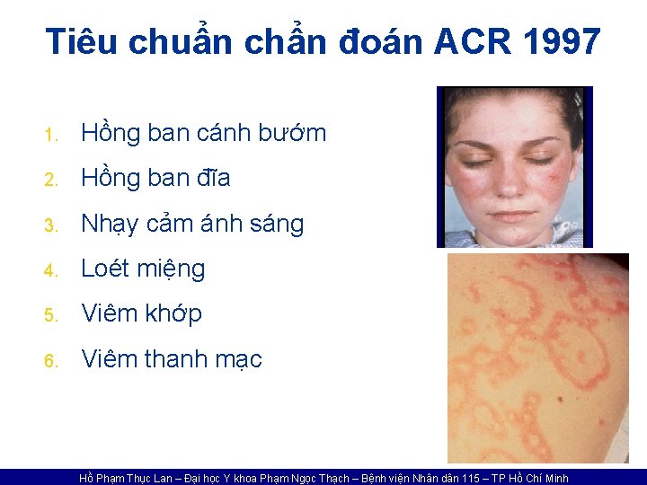 Tiêu chuẩn chẩn đoán ACR 1997 1. Hồng ban cánh bướm 2. Hồng ban
