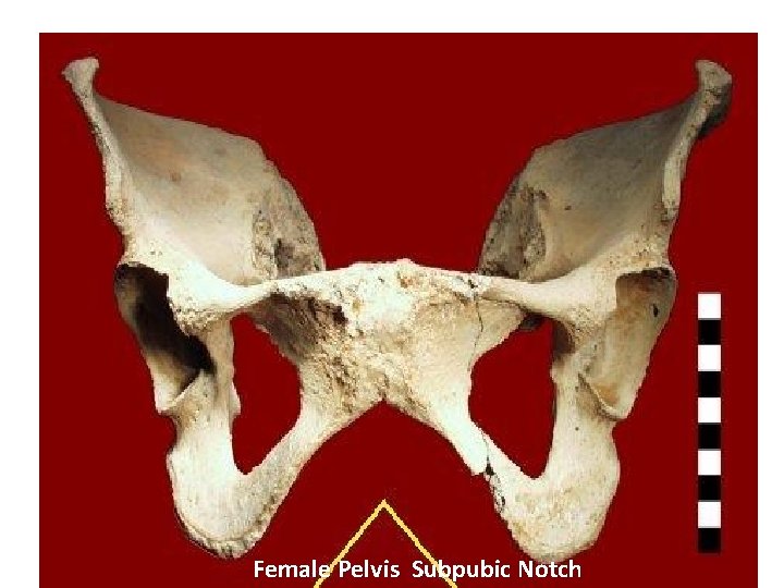 Female Pelvis Subpubic Notch 