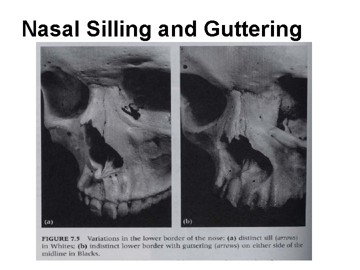 Nasal Silling and Guttering 