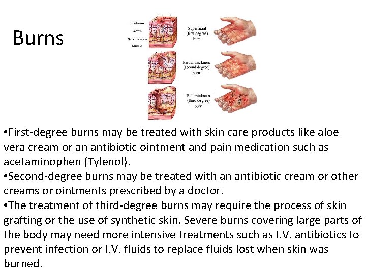 Burns • First-degree burns may be treated with skin care products like aloe vera