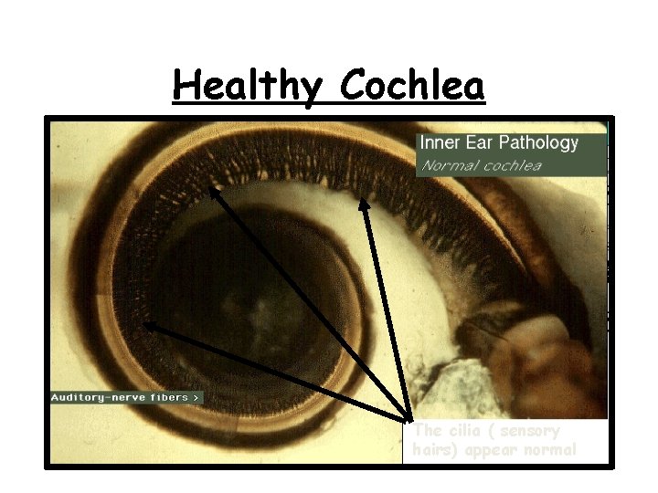 Healthy Cochlea The cilia ( sensory hairs) appear normal 