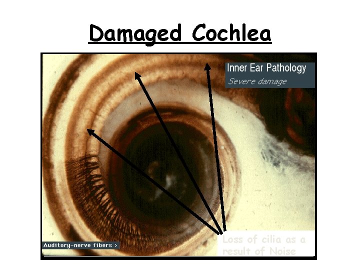 Damaged Cochlea Loss of cilia as a result of Noise 