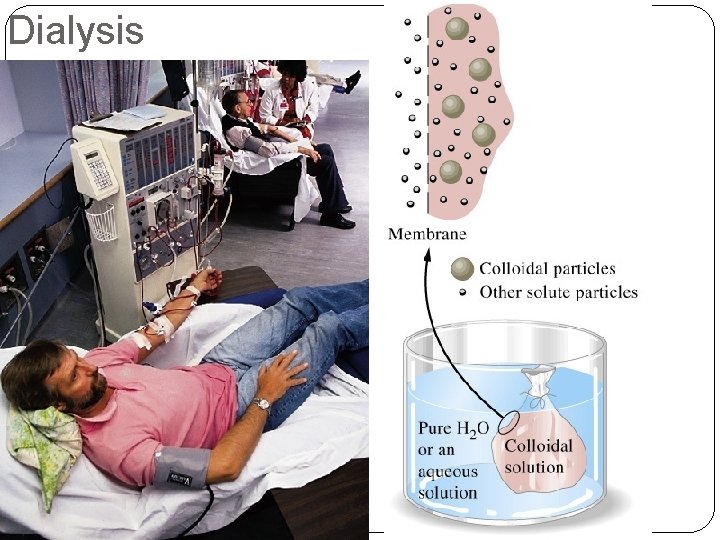 Dialysis 