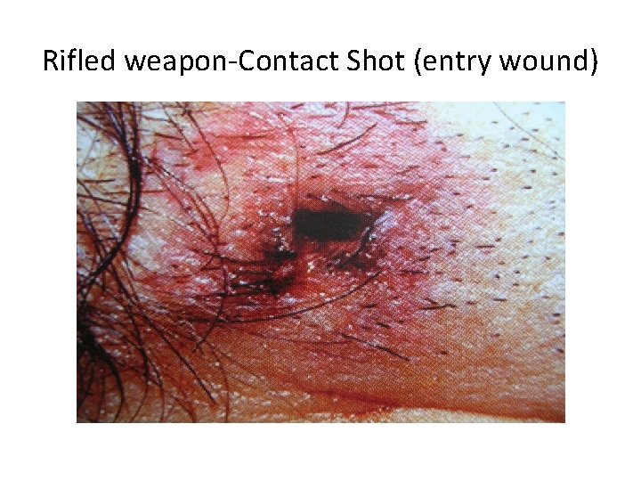 Rifled weapon-Contact Shot (entry wound) 