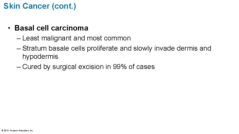 Skin Cancer (cont. ) • Basal cell carcinoma – Least malignant and most common