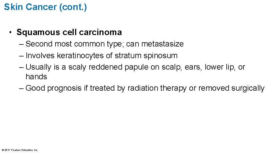 Skin Cancer (cont. ) • Squamous cell carcinoma – Second most common type; can