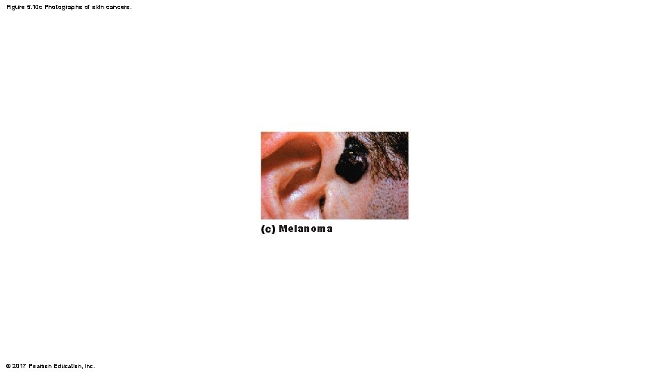 Figure 5. 10 c Photographs of skin cancers. Melanoma © 2017 Pearson Education, Inc.