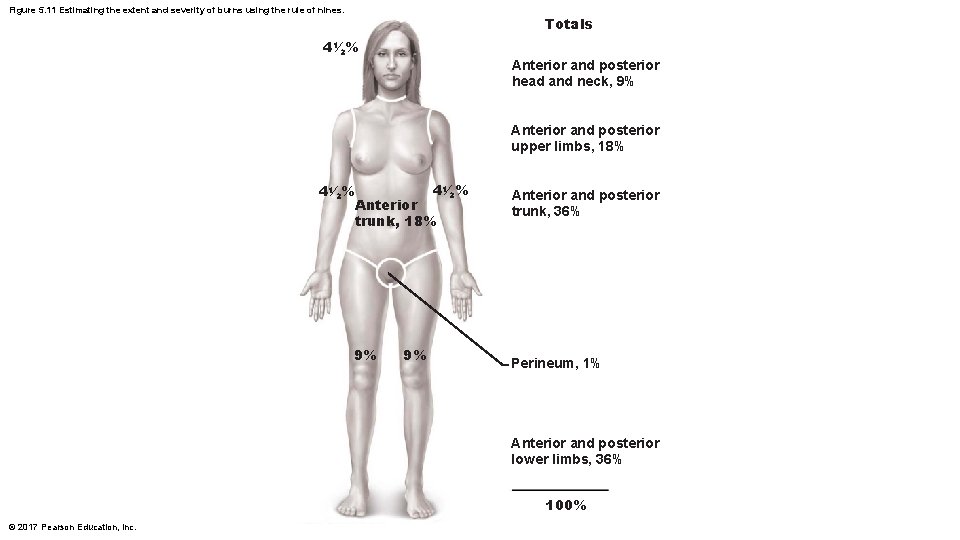 Figure 5. 11 Estimating the extent and severity of burns using the rule of