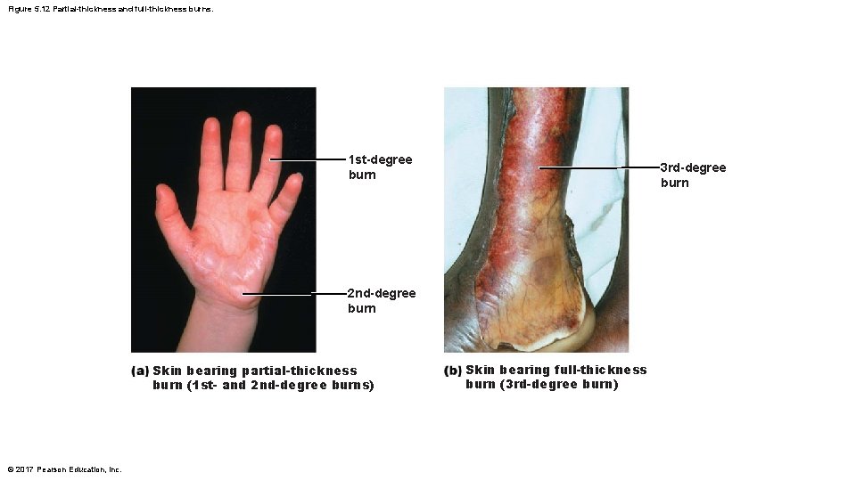 Figure 5. 12 Partial-thickness and full-thickness burns. 1 st-degree burn 3 rd-degree burn 2