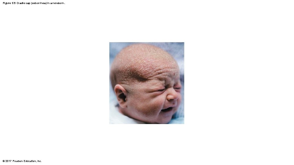 Figure 5. 9 Cradle cap (seborrhea) in a newborn. © 2017 Pearson Education, Inc.