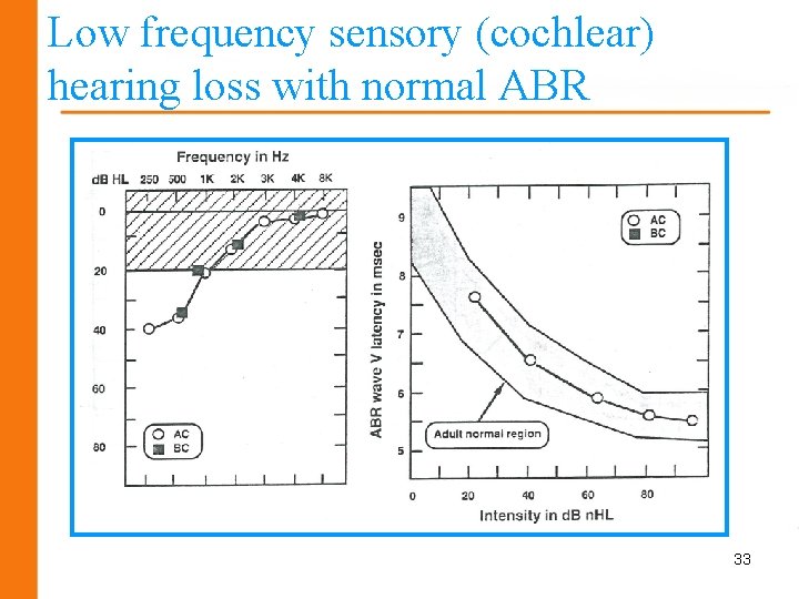 Low frequency sensory (cochlear) hearing loss with normal ABR 33 