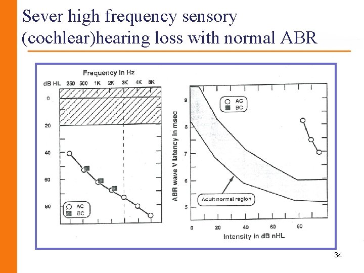 Sever high frequency sensory (cochlear)hearing loss with normal ABR 34 