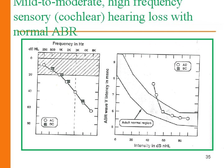 Mild-to-moderate, high frequency sensory (cochlear) hearing loss with normal ABR 35 