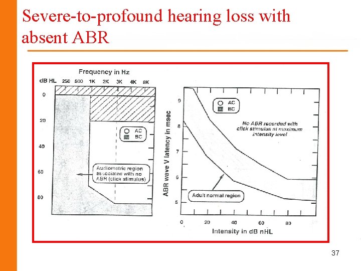 Severe-to-profound hearing loss with absent ABR 37 