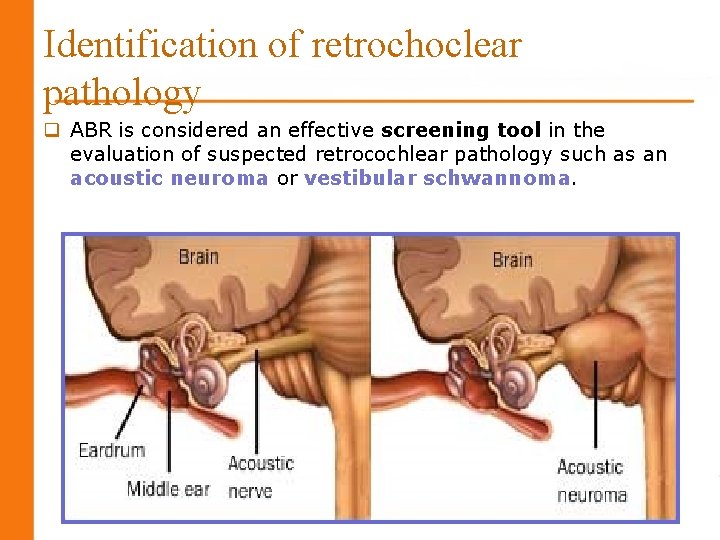 Identification of retrochoclear pathology q ABR is considered an effective screening tool in the