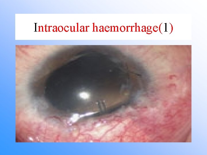 Intraocular haemorrhage(1) 