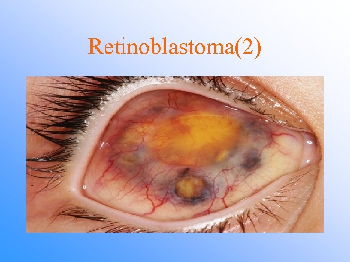 Retinoblastoma(2) 