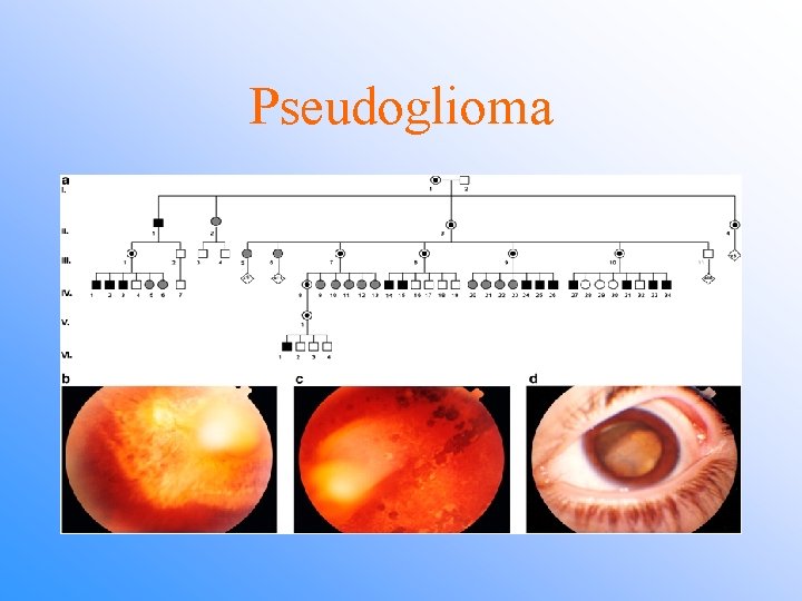 Pseudoglioma 