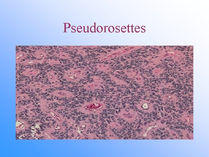 Pseudorosettes 