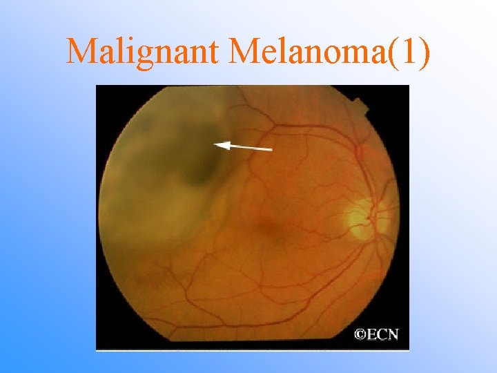 Malignant Melanoma(1) 