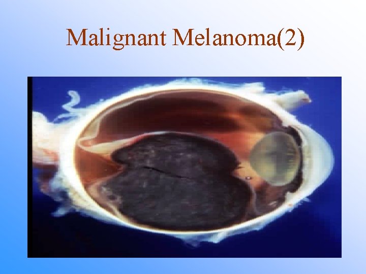 Malignant Melanoma(2) 