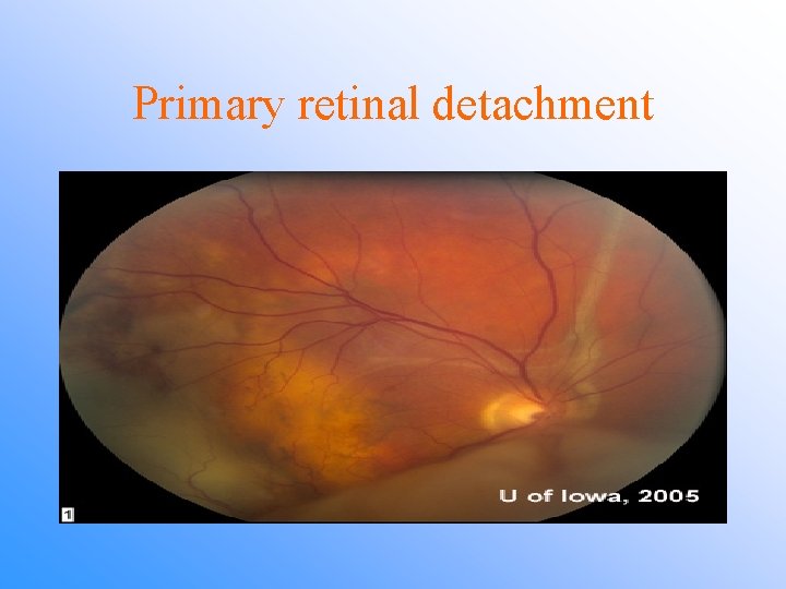 Primary retinal detachment 