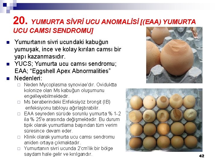 20. YUMURTA SİVRİ UCU ANOMALİSİ [(EAA) YUMURTA UCU CAMSI SENDROMU] n n n Yumurtanın