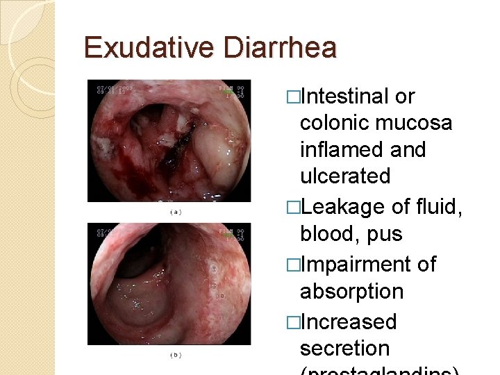 Exudative Diarrhea �Intestinal or colonic mucosa inflamed and ulcerated �Leakage of fluid, blood, pus
