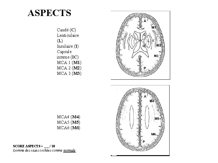 ASPECTS Caudé (C) Lenticulaire (L) Insulaire (I) Capsule interne (IC) MCA 1 (M 1)